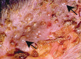 <p>Líquido localizado entre la epidermis o por debajo de ella</p><p>Reacción adversa a medicamentos, quemaduras por calor o químicos</p>
