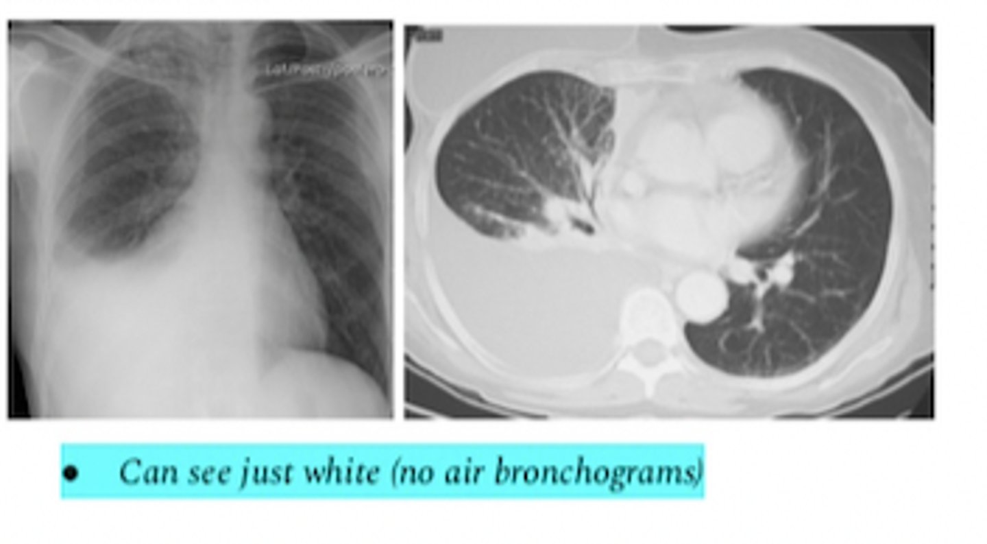 <p>what does this xray and CT show</p>