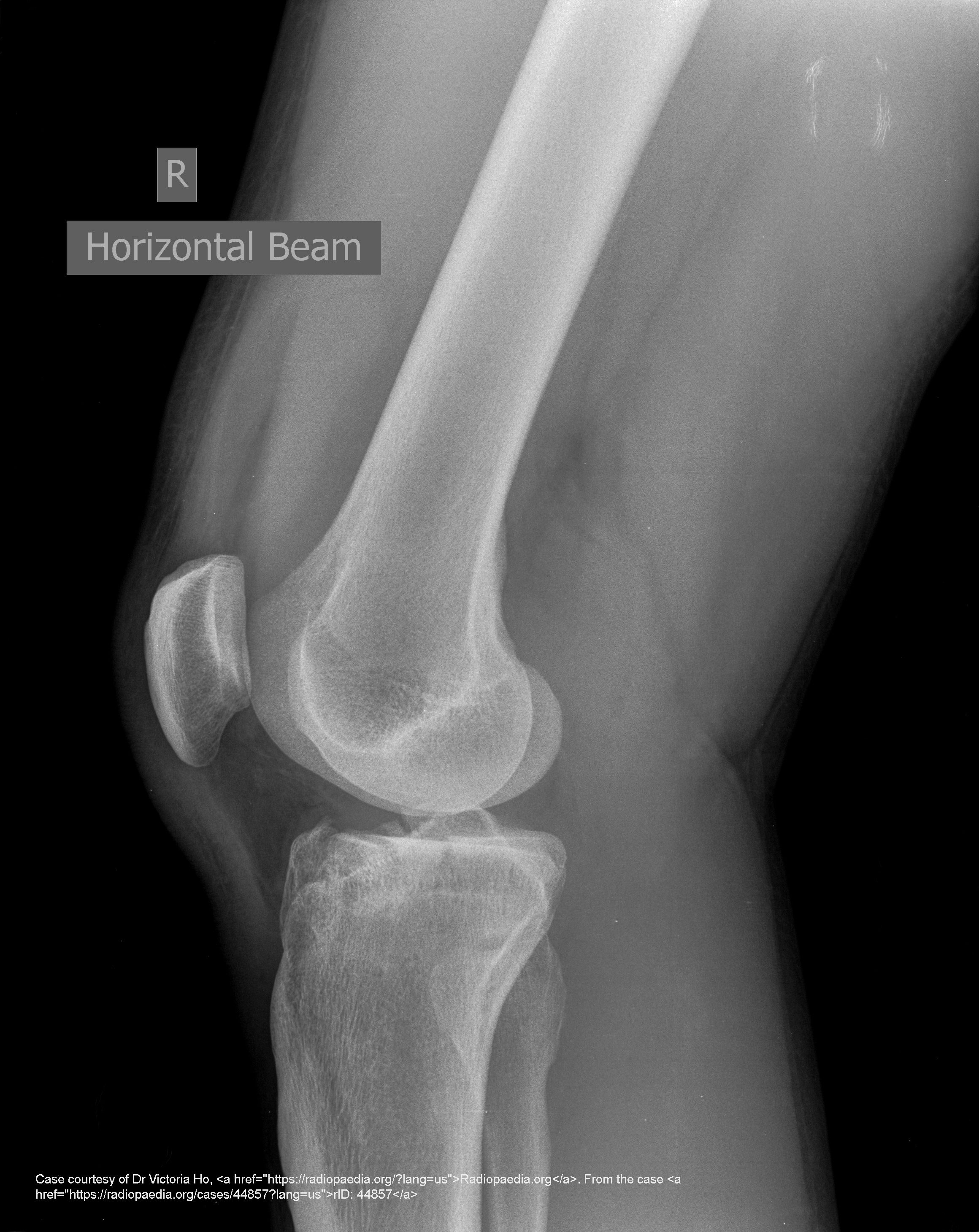 <p>What signs suggest a tibial plateau fracture?</p>