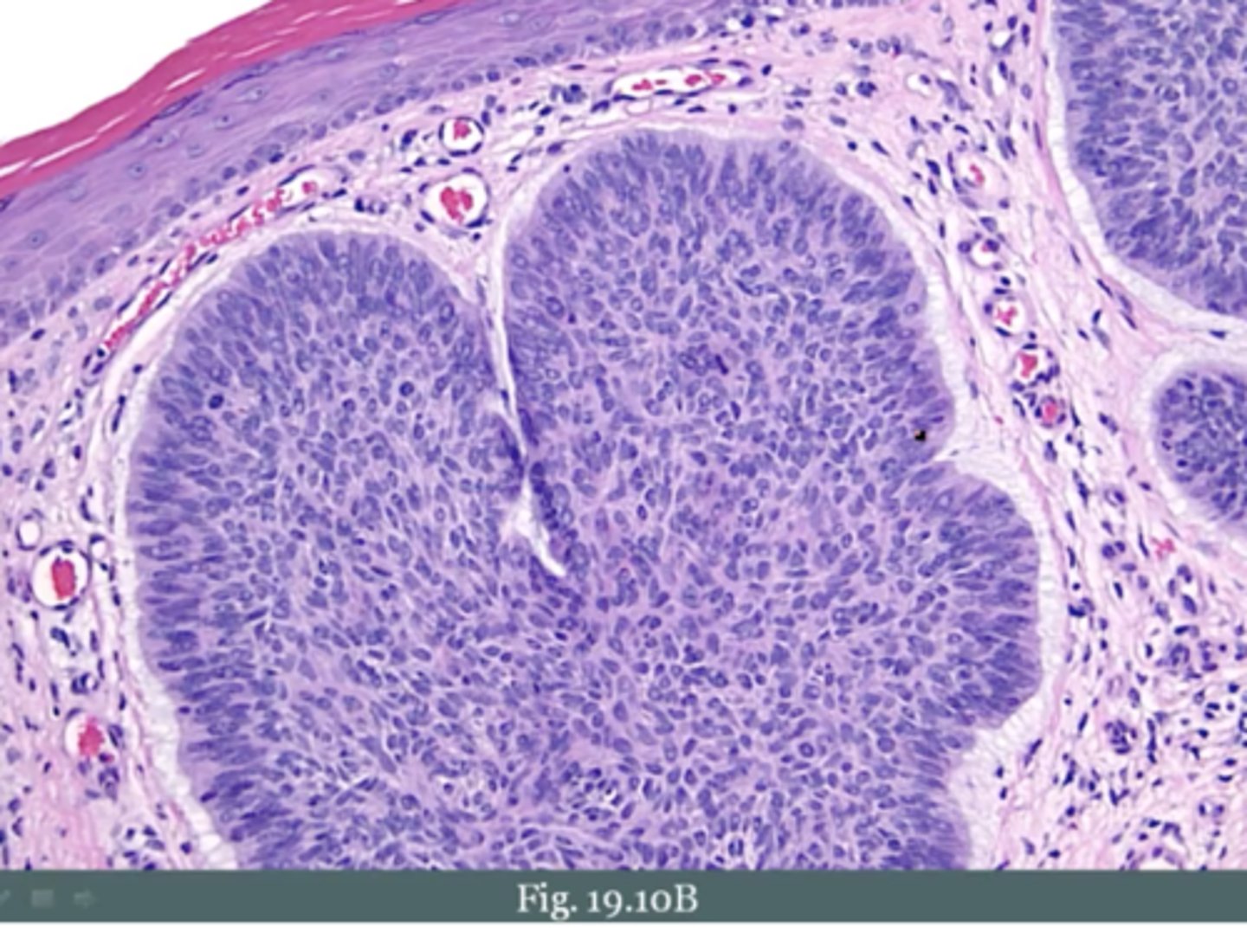 <p>"Palisading (aligned) nuclei"</p>