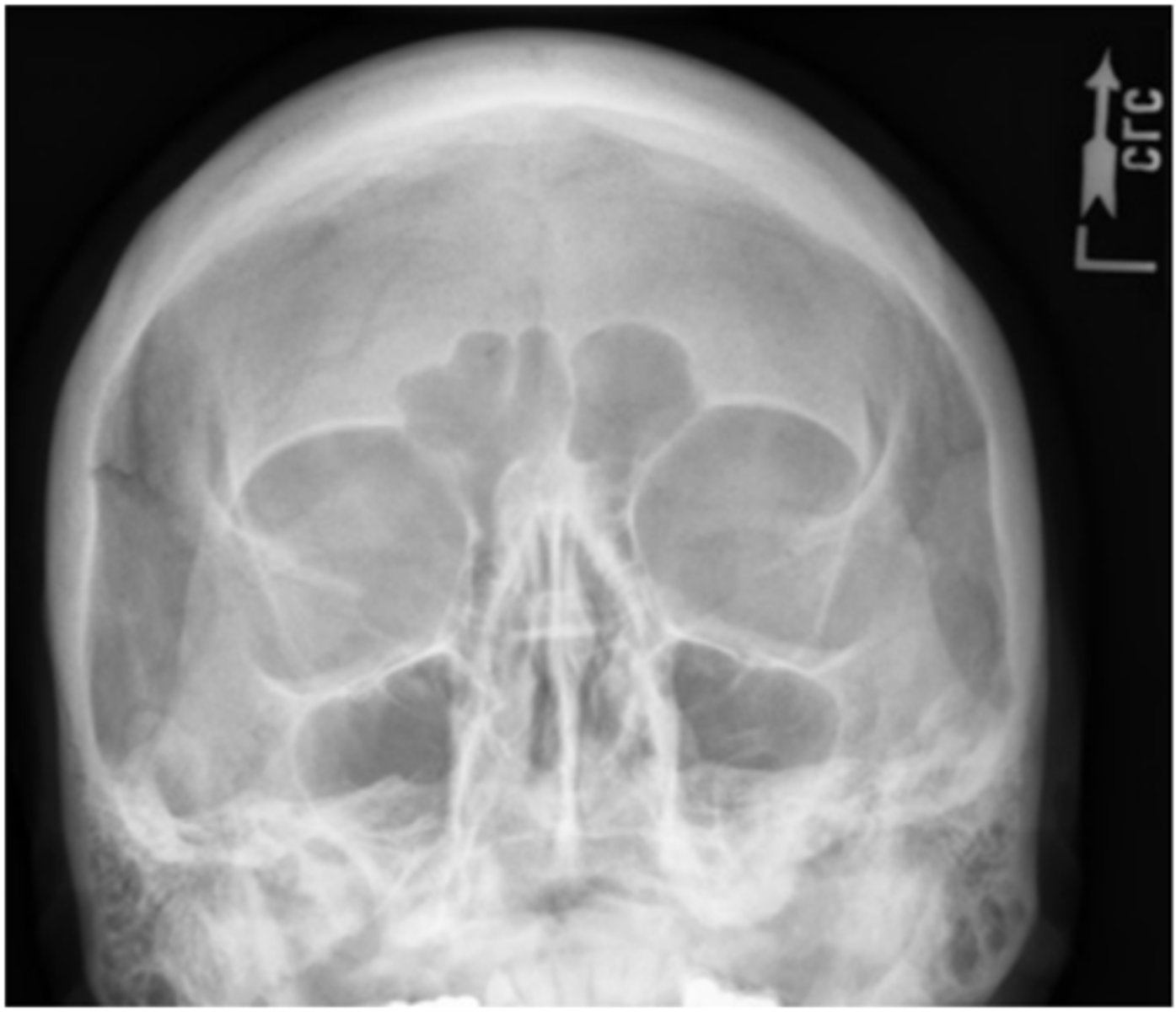 <p>-Position:</p><p>• Correct position/CR angulation is indicated by petrous ridges projected into the lower half of the maxillary sinuses, below the IOMs.</p><p>• No rotation of the cranium is indicated by equal distance from the midlateral orbital margin to the lateral cortex of the cranium.</p>