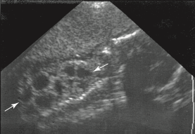 <p><span><span>A patient arrives for a second-trimester screening sonogram. A sagittal image of the fetus is most suspicious for which of the following pathologies?</span></span></p>