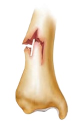 <p>fracture</p>