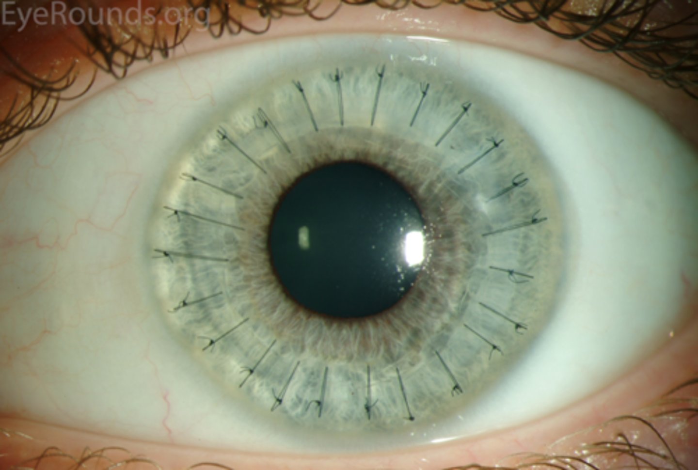 <p>What is the con of 16-30 interrupted sutures used in PKP?</p>
