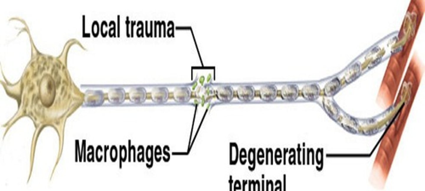 <p>degeneration of the distal portion of the axon and myelin sheath</p>