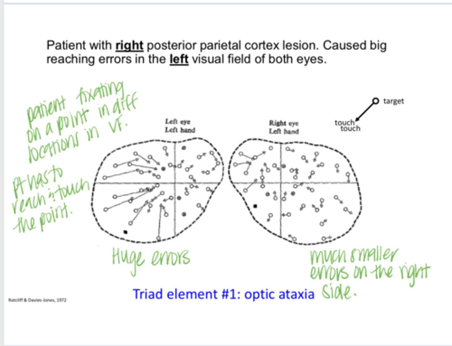 <p>A patient with RIGHT posterior parietal cortex lesions will have reaching errors in the (right/left) VF of both eyes</p>