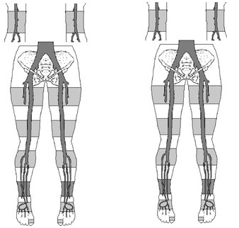 <p>1.Is this a 3 cuff method or 4 cuff? </p><p>2.How will the diagnostic criteria change depending on the cuff method? </p><p>3.Why do they differ?</p>