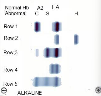 <p>Identify the hemoglobin bands present, from cathode (negative) to anode (positive), in the sample shown in lane 5 of this alkaline hemoglobin electrophoresis.</p><p>CSA</p><p>ASC</p><p>SFA</p><p>AFS</p>