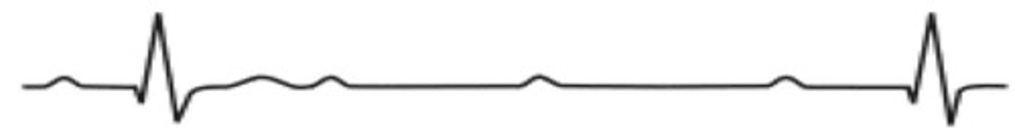 <p>Which type of arrhythmia is this?</p>