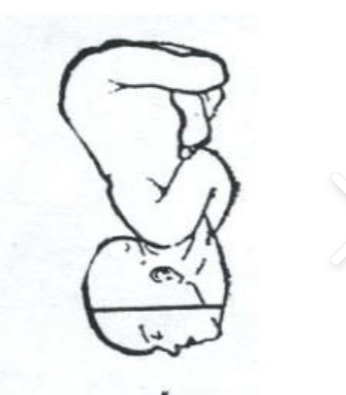 <p>vaginal delivery may be possible if chin is anterior;<strong> fetal head is fully extended, with the face as the presenting part</strong>; may require C-section if mentum posterior</p>