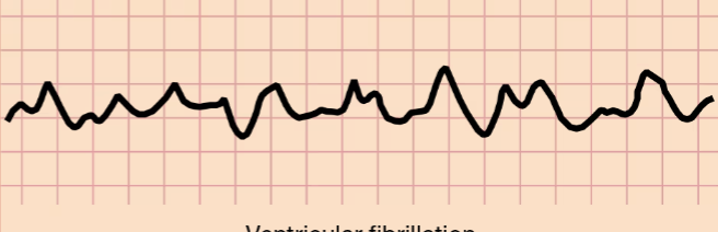 <p>Ventricular Fibrillation </p>