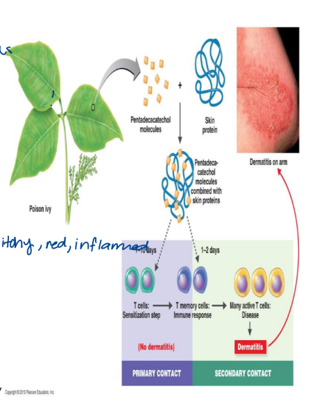 <ul><li><p>this is delayed hypersensitivity</p></li><li><p>it is the result of cell mediated response (cytotoxic T cells)</p><ul><li><p>not antibody mediated</p></li><li><p>this causes a delay reaction 24-72 hours after contact</p></li><li><p>it results from the activation of memory T cells</p></li><li><p>ex. contact dermatitis: chemical reactions</p><ul><li><p>abnormal looking skin cells</p></li></ul></li></ul></li><li><p>how does it happen?</p><ul><li><p>small chemicals interact with the skin proteins to from antigen</p></li><li><p>this causes a change in skin cells </p></li><li><p>the cell mediated immune response acts against foreign or abnormal cells</p></li><li><p>targets a localized area of the skin</p></li><li><p>cytotoxic T cells destroy skin cells: causes red, itchy, swollen skin</p></li></ul></li></ul><p>ONLY CELL MEDIATED</p><p></p>