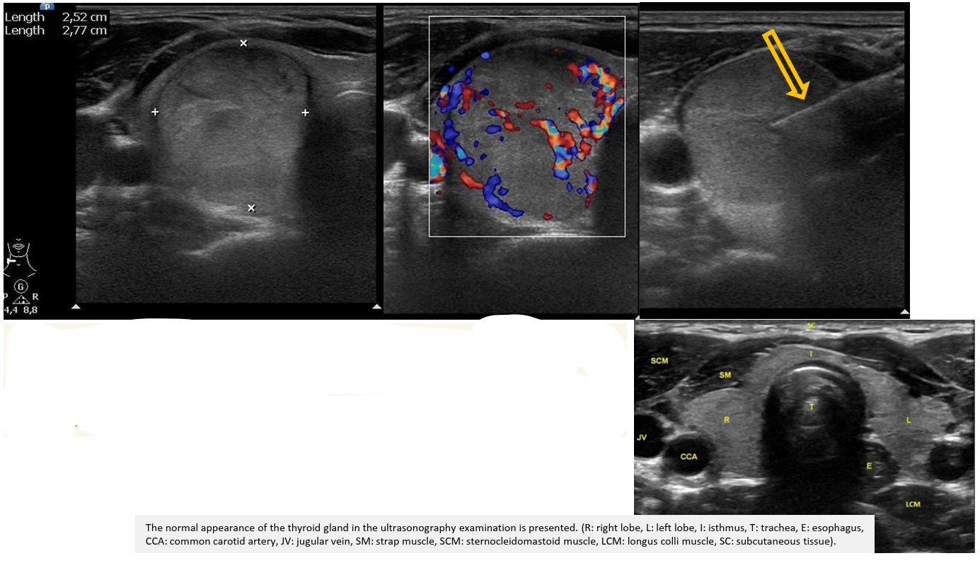 <p>Patient history: palpable, unpainful mass in the right side of the neck </p><p>Modality: linear probe (7,5–10 MHz), left – B-mode US, middle – Color Doppler US, right – B-mode US </p><p>Region: neck, thyroid gland </p><p>Radiologic sign: well-circumscribed, isoechoic, vascularized nodule; FNAB (fine-needle aspiration biopsy), echodense needle (yellow arrow) </p><p>Diagnosis: suspicious thyroid nodule, cytology proved benignity</p>