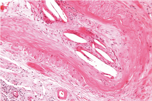 <p><span>A 77-year-old male presents to the office for follow-up after undergoing coronary angiography via femoral approach for stable angina 4 days ago. He feels well today and has no concerns. Past medical history reveals hypertension, hyperlipidemia, and type 2 diabetes mellitus. Vital signs and physical examination are normal. Laboratory studies reveal a blood urea nitrogen of 30 mg/dL (reference range: 6–20 mg/dL) and a serum creatinine of 2.7 mg/dL (reference range: 0.7–1.3 mg/dL). Prior to catheterization, his serum creatinine was 1.0 mg/dL. A renal biopsy is obtained, as shown in the exhibit.&nbsp;</span></p><p><span>The most likely cause of this patient's acute kidney injury is </span></p>