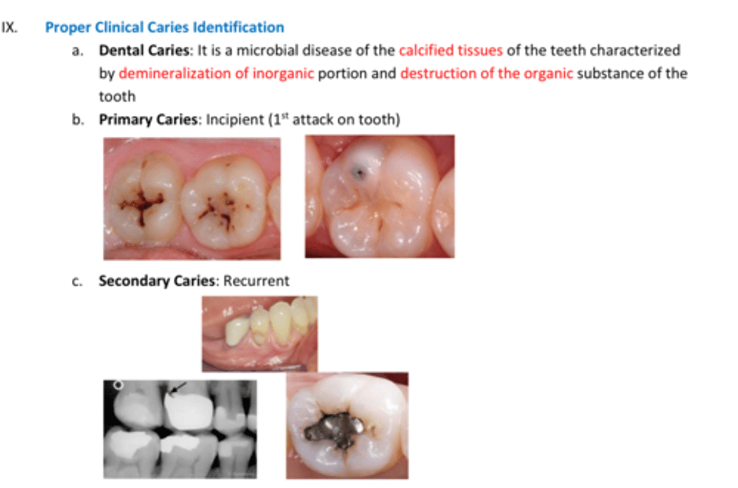 <p>Primary caries=</p><p>Secondary caries=</p>