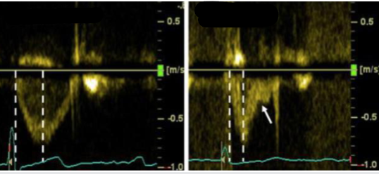 <p>Compare these two tracings of the same valve on different patients. What valve is being measured? Which is normal and which is abnormal? What does the abnormal tracing indicate?</p>