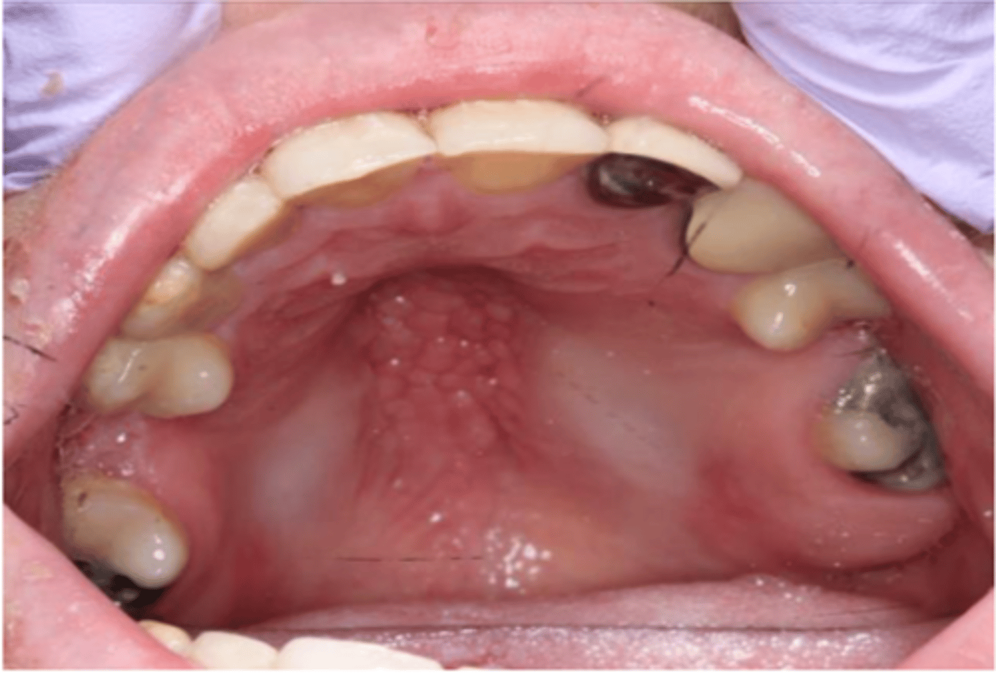<p>Inflammatory papillary hyperplasia may also</p><p>be seen in patients who are ...</p>