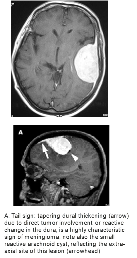 <p>false - typically benign neoplasm arising from meninges </p>