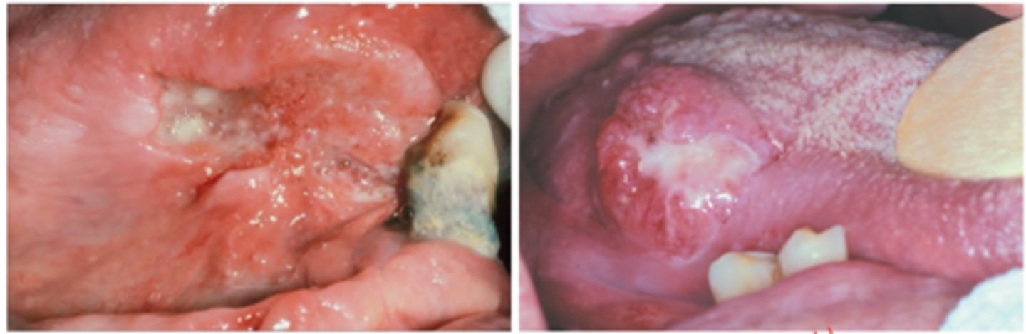 <p>Hint: most common sites of this pathology are tongue (posterior lateral and ventral) and floor of mouth</p>