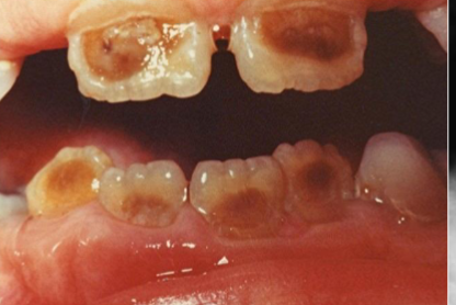 <p>affects enamel, resulting in defective enamel formation and varying degrees of translucency and thickness</p>