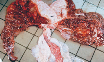 <p>What does this placenta show?</p>