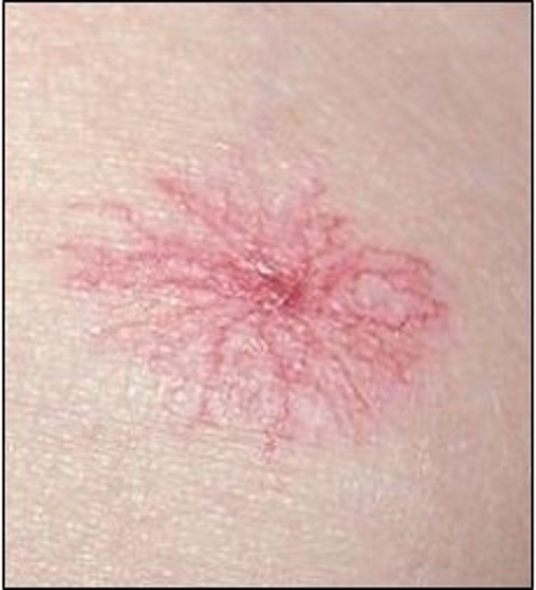 <p>red body with "legs"</p><p>dilated small vessels that are red or blue</p>
