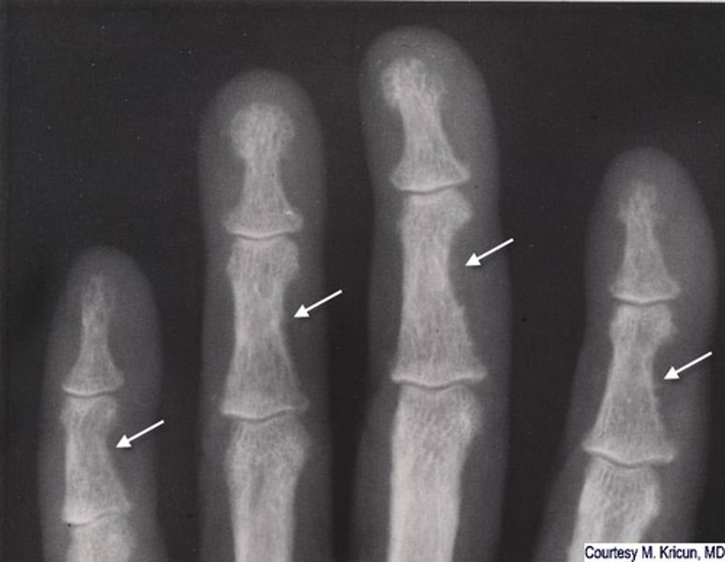 <p>excessive secretion of PTH, stimulating osteoclastic activity, calcium removed from bone and deposited in bloodstream -&gt; hypercalcemia</p><p>- decrease in bone density</p><p>- subperiosteal bone resorption of fingers</p><p>- erosion of distal clavicles</p><p>- well-circumscribed lytic lesions in long bones called brown tumors</p>