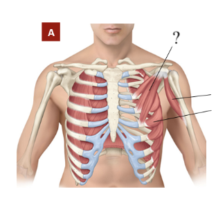 <p>deep, has 3 heads that connect to a few superior ribs to the coracoid process</p><ul><li><p>works with the serratus anterior muscle to move the scapula bone anterior and laterally</p></li></ul><p></p>