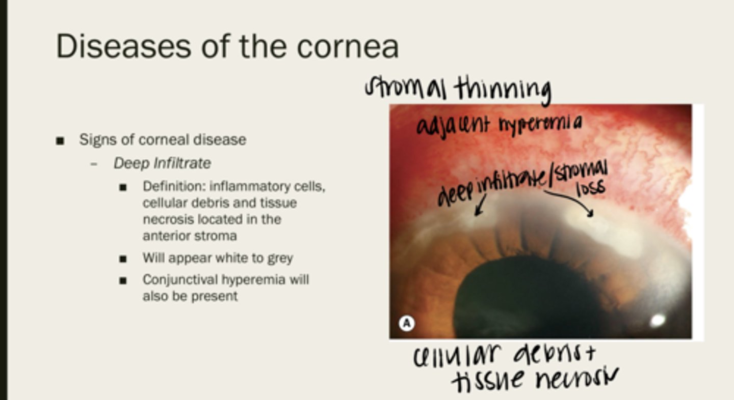 <p>How will deep infiltrates of the corneal stroma appear?</p>