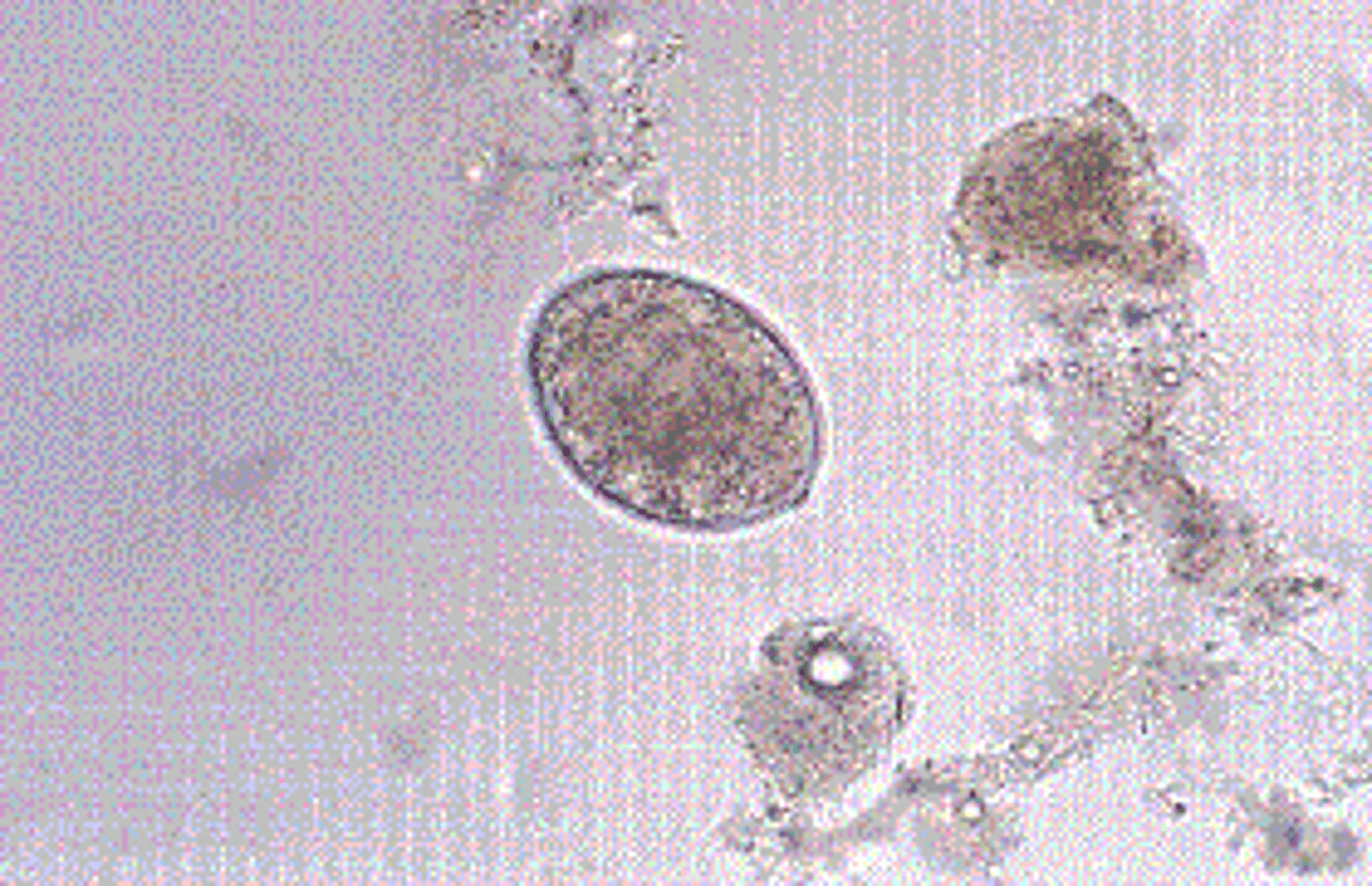 <p>c.Diphyllobothrium latum</p><p>D. latum, the fish tapeworm, is found worldwide in areas where the population eats pickled or raw fresh water fish. In the United States, it is primarily seen in the areas around the Great Lakes. The organism may cause a vitamin B12 deficiency, especially in persons of northern European descent, and long-term infection can lead to a megaloblastic anemia. The egg is operculated and yellow-brown, about 58 to 76 μm by 40 to 50 μm and has a small, knoblike protuberance at the end opposite the operculum</p>