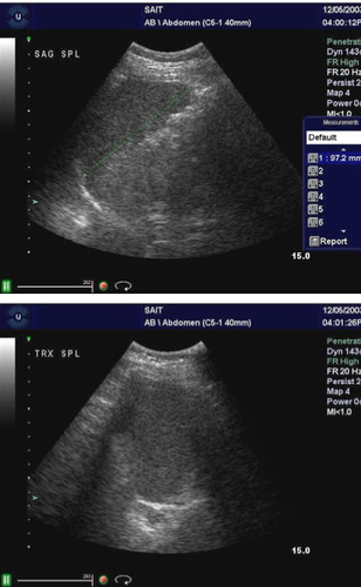 <p>What is indicated when the spleen starts to loose the normal shape of an inverted comma</p>