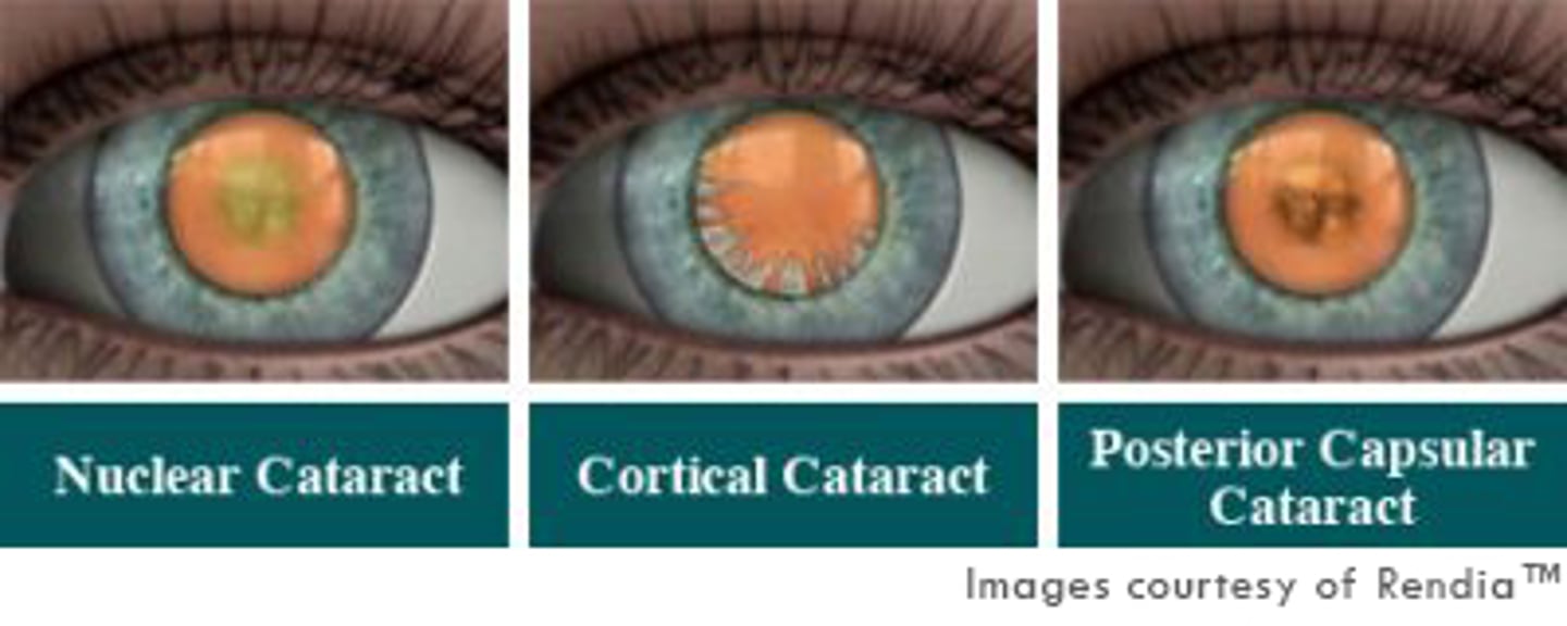 <p>Nuclear</p><p>Cortical</p><p>Subcapsular (posterior)</p>