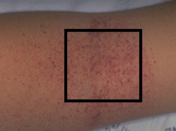 <p>Torniquet test</p>