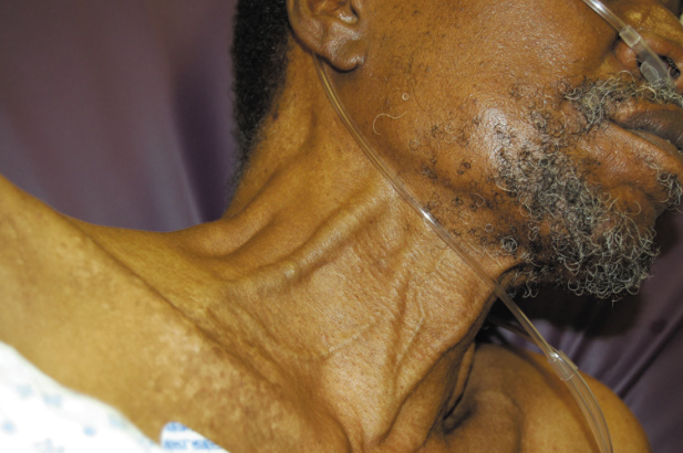 <p><strong>JVD</strong> - Jugular Vein Distension </p>