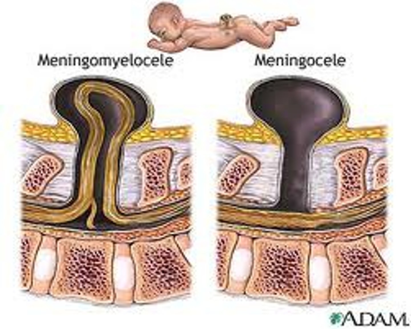 <p>a form of spina bifida in which meninges protrude through defect in the vertebral arches but the spinal cord and nerves do not</p>