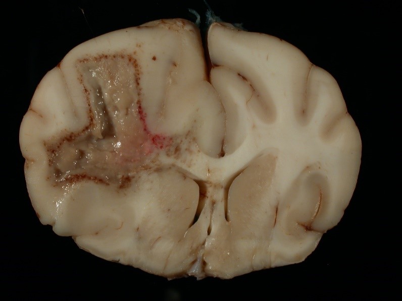 <p><span><span>The image depicts a brain from a dog. In this type of necrosis, enzymatic digestion of cells predominates over protein denaturation and grossly (macroscopically), there is accumulation of soft, viscous, fluid. This is an example of what type of necrosis?</span></span></p><p>Coagulation (coagulative) necrosis</p><p></p><p>&nbsp;</p><p>Caseous necrosis</p><p>&nbsp;</p><p>Liquefactive (lytic) necrosis</p>