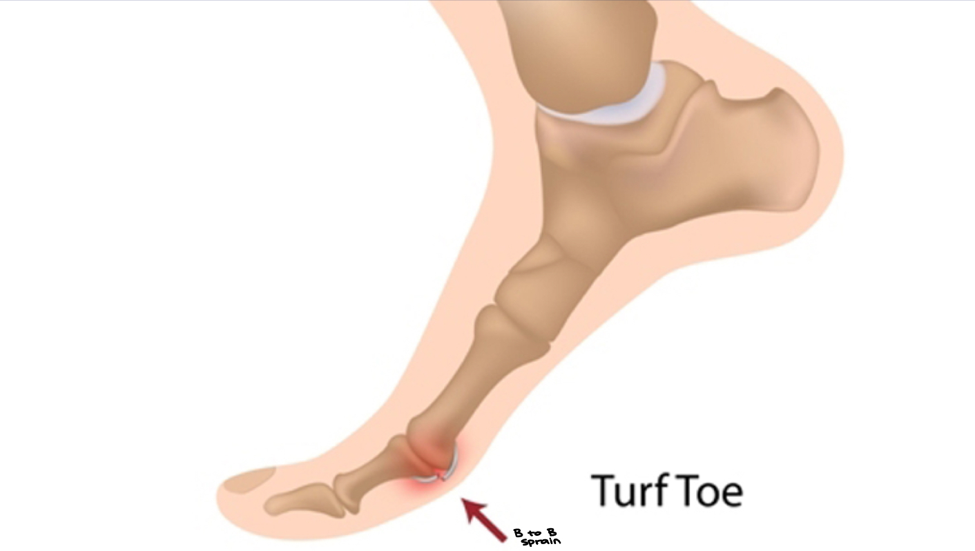 <ul><li><p>Swelling → pressure → pain</p></li><li><p>5 signs of inflammation! Pressure is NOT one = PAIN!! Pharm &amp; pain &amp; vet school! Kill most of the pain but NOT all </p></li><li><p>Pain is an evolutionary significant mechanism to tell vertebrate you are wounded so we can repair it </p></li><li><p>Animals: difference w/ regards to pharmacology associated w/ pain </p></li><li><p><strong><em>Question: </em></strong>joint is a condyloid joint, it can flex, extend, a<strong><em>D</em></strong>uct, &amp; a<strong><em>B</em></strong>duct </p></li><li><p>Parity… supinator &amp; pronator teres </p></li></ul><p></p>