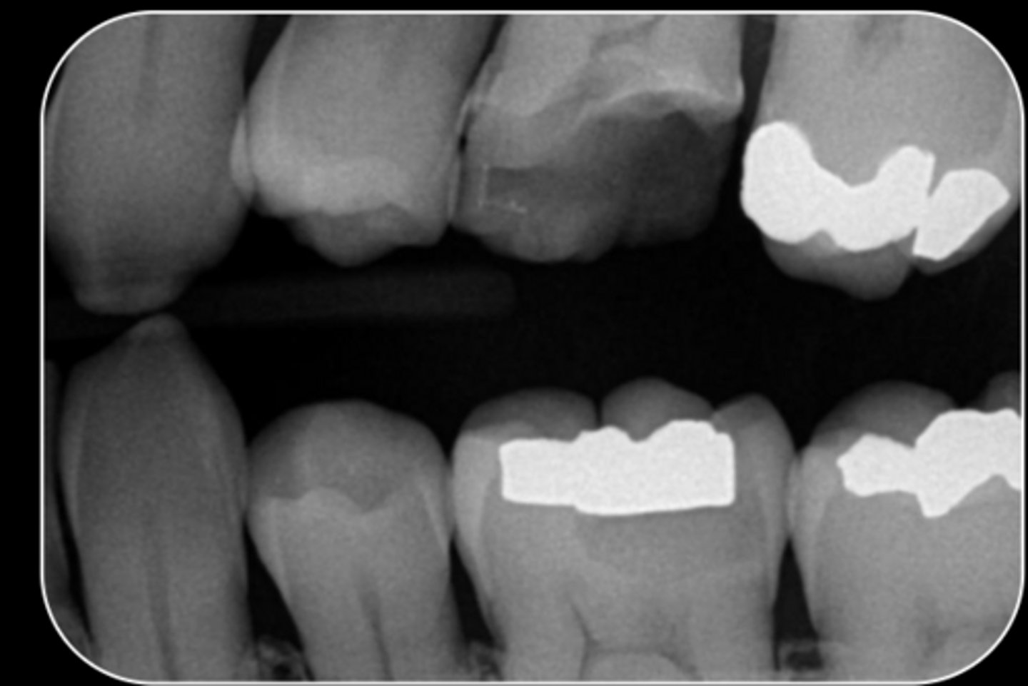 <p>What are the radiographic findings on #14?</p>