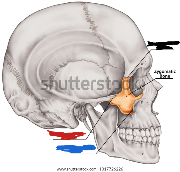 <p>temperozygomatic suture (lateral view)</p>