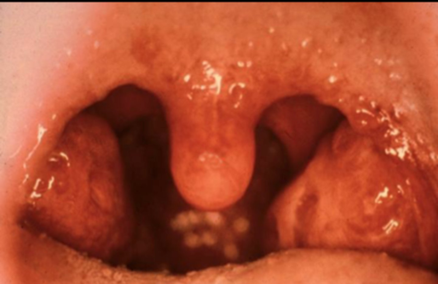 <p>Uvula</p>