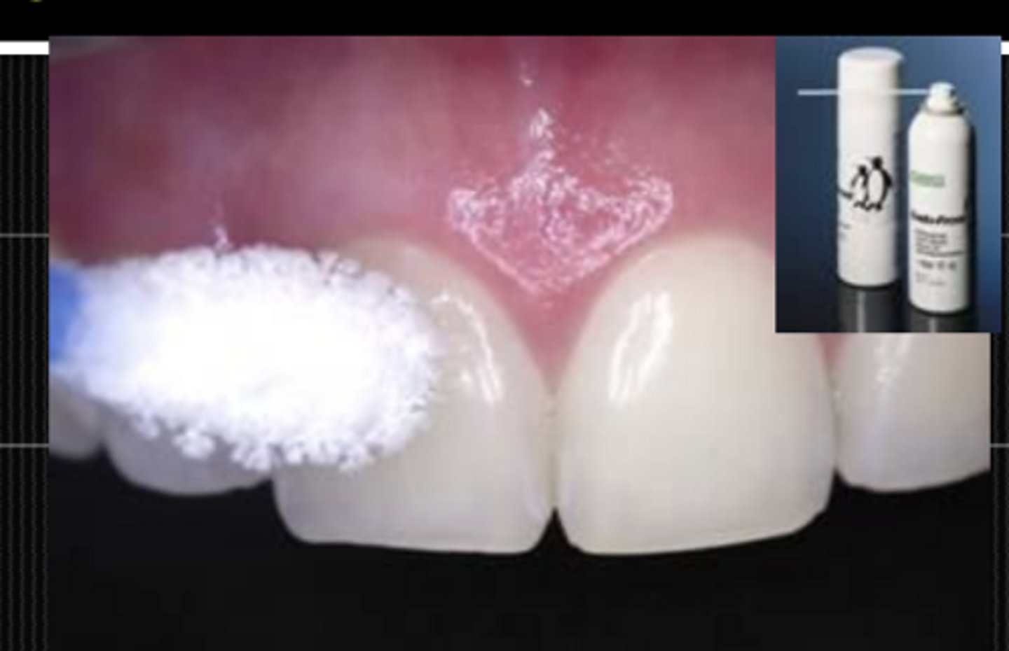 <p>- Cold test</p><p>- Electric Pulp Test (EPT)</p><p>--- In case of lingering pain = endo</p>