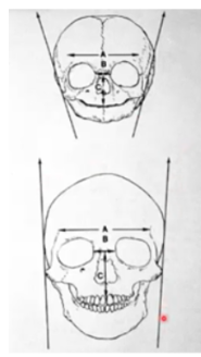 <p>-small changes in cranial width (A) and interorbital width (B) between newborn and adult</p><p>-large changes in facial width (bizygomatic width) and upper facial height (C) between newborn and adult</p><p>-newborn much wider than visceral cranium (splanchnocranium); in adult these plans are much closer because of increase in size of zygomatic bone</p>
