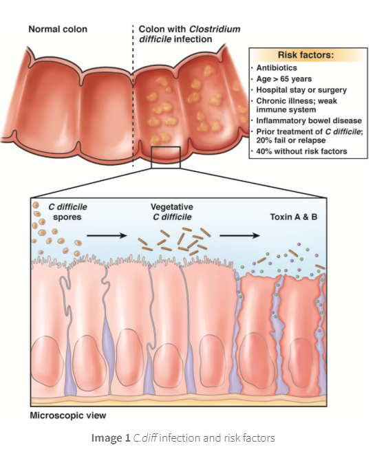 <p><span style="color: purple;"><strong>Clostridiodes difficile C diff</strong></span></p>