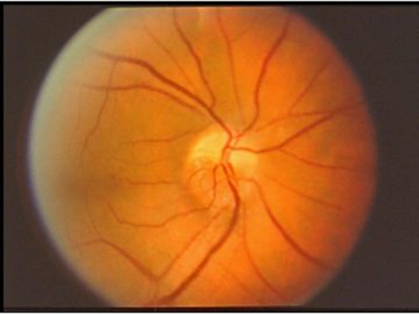 <p>NAAION or AAION = ischemic event like a local infarction of the post ciliary arteries</p>