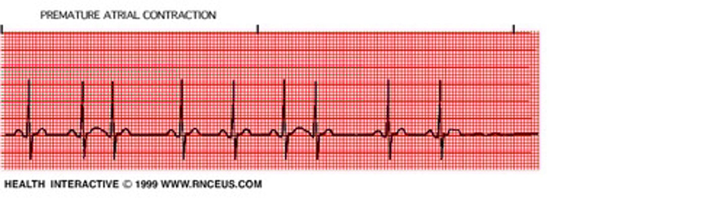<p>- originates suddenly in irritable atrial foci</p><p>- P' is earlier than expected and diff shape than P (often have a pause following PAC)</p><p>- can occur in Bigeminy, Trigeminy, Quadgeminy pattern</p>