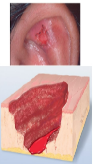 <p>deeper depression extending into dermis w/ irregular shape, may bleed, leaves scar</p>