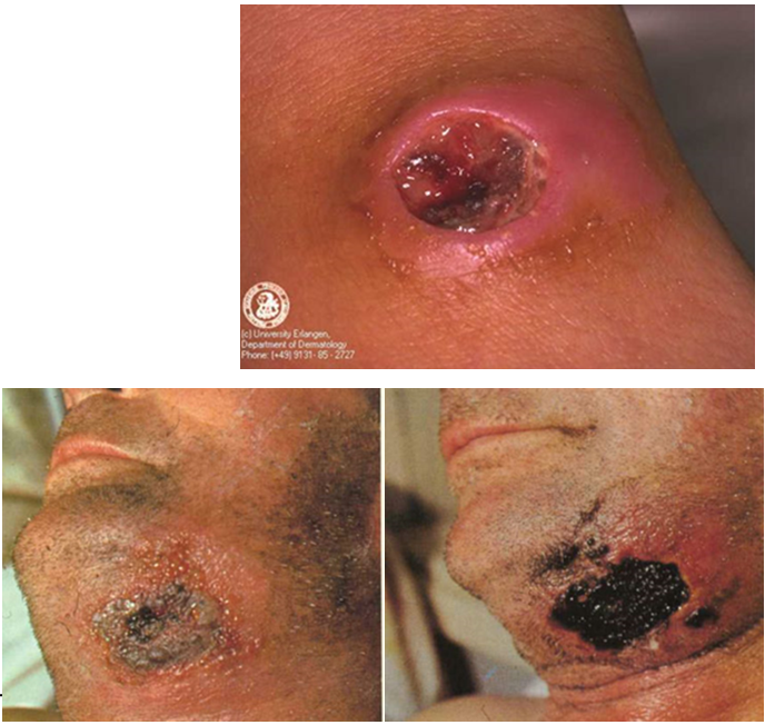 <p>An ulcer with a<strong> black eschar </strong>and <strong>swelling (edema)</strong>.</p>