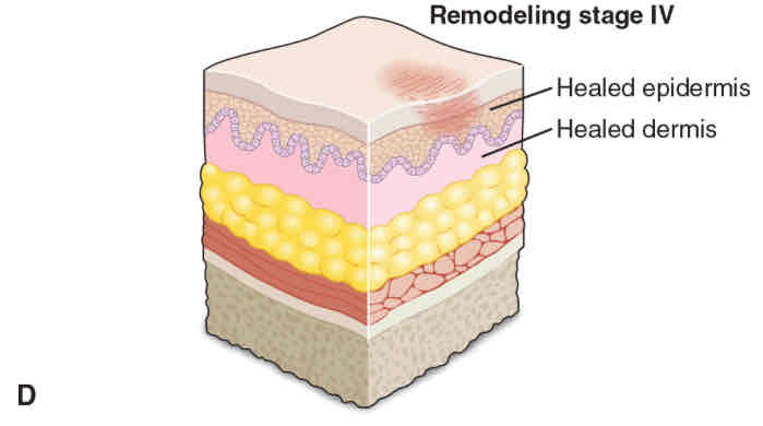 <p>Scar tissue is structurally refined and reshaped by <strong>fibroblasts</strong> and <strong>myoblasts</strong></p><ul><li><p><strong>Takes ~3 weeks after injury to start remodeling</strong></p></li></ul><p></p>