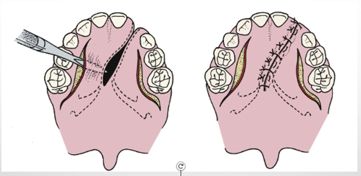 <p>which palatorrapphy method:</p><p>- closure of the hard palate using lateral releasing incisions</p><p>- one-layer closure.</p><p>- Nasal (i.e., superior) aspect of palatal flaps will epithelialize, as will denuded areas of the palatal bone.</p>