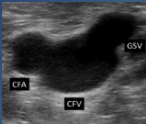 <p>What is site 2 for a DVT?</p>